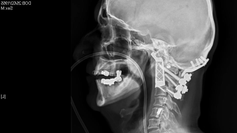 Médicos usam vértebra feita em impressora 3D para ajudar um paciente a andar